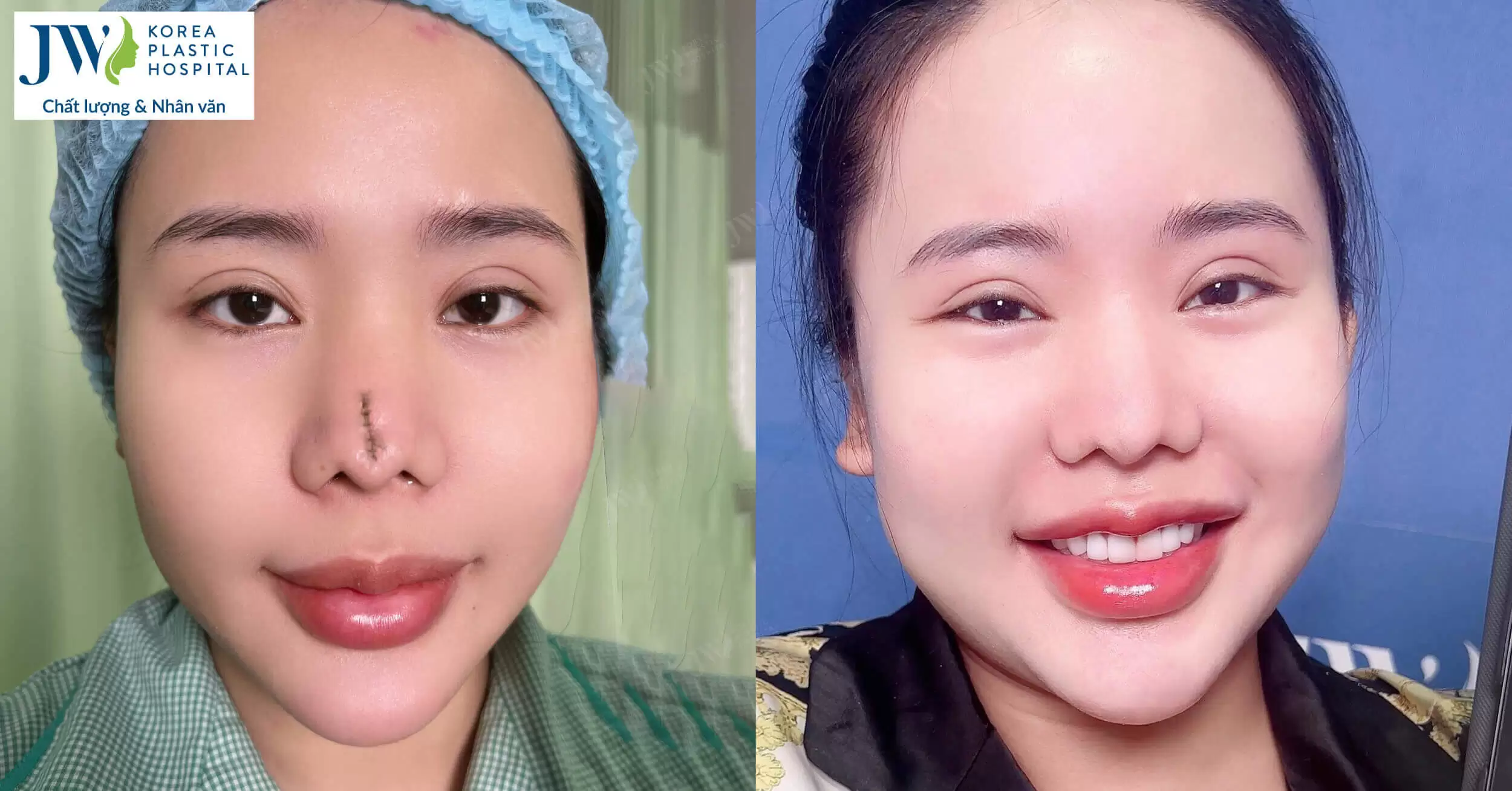 Bác sĩ Tú Dung cấp cứu thành công mũi hỏng do tai nạn