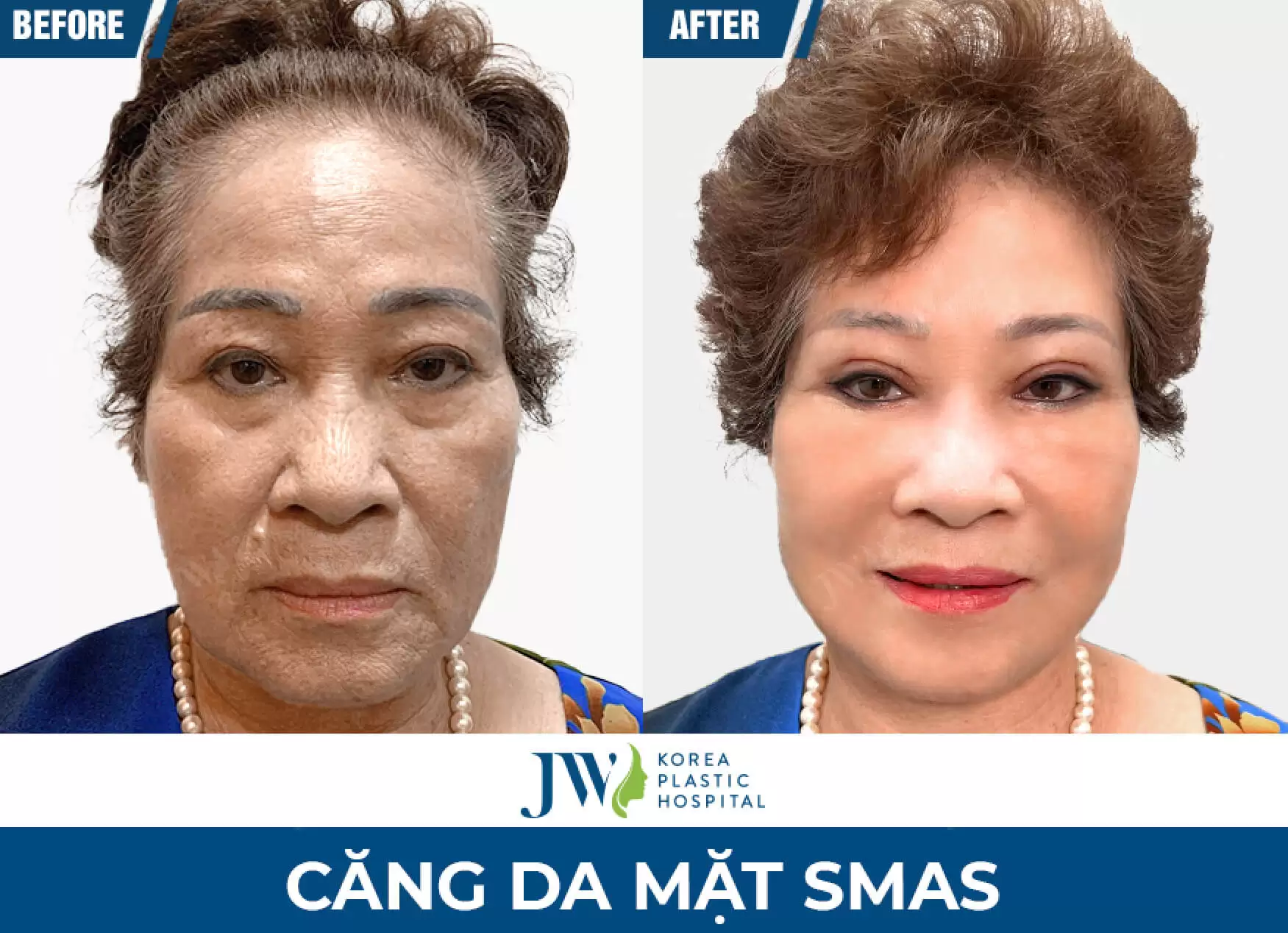 cang da mat smas