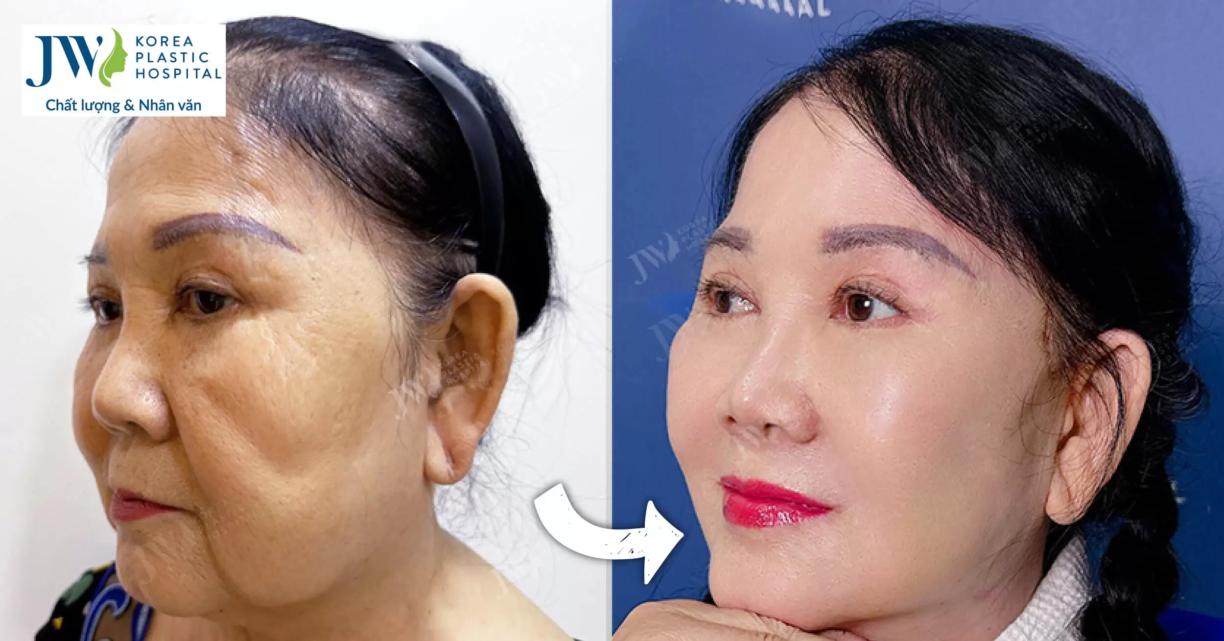 Những biến chứng khi căng da mặt bạn có thể gặp phải