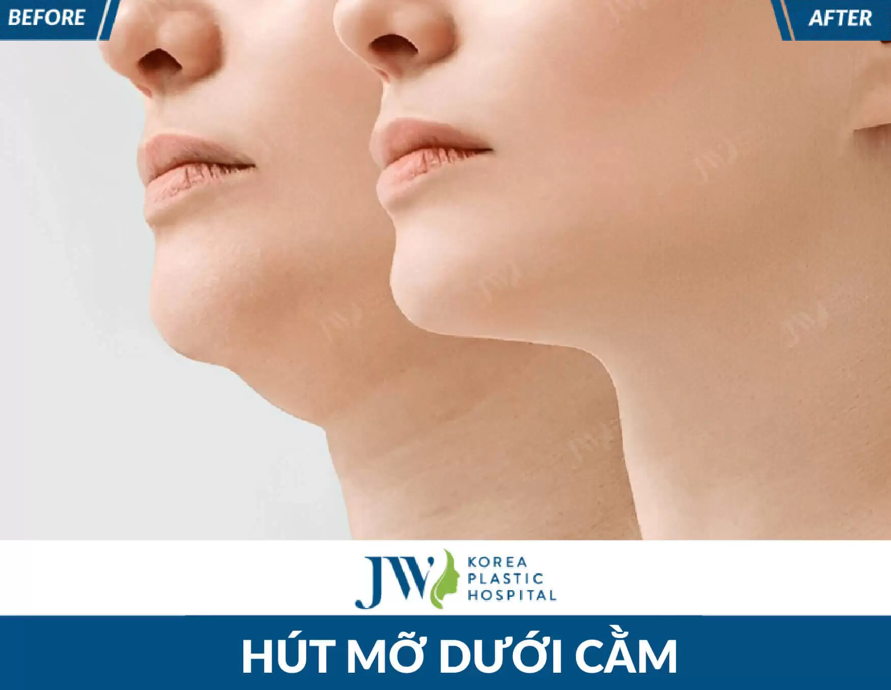 hut mo duoi cam dep