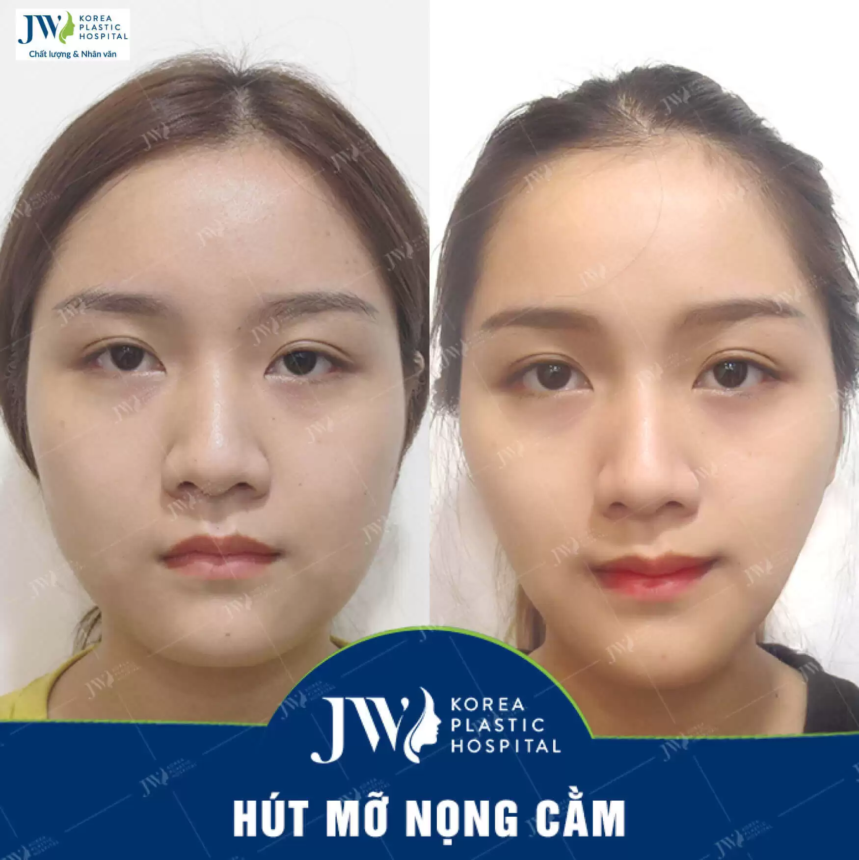mỡ nọng cằm