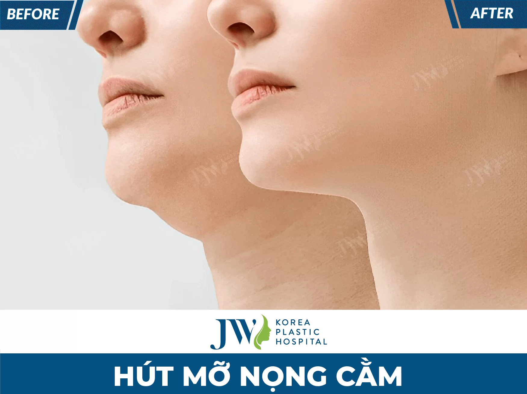 hut mo nong cam