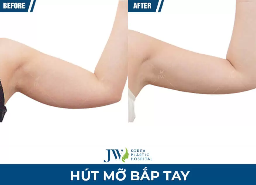 mo bap tay 1