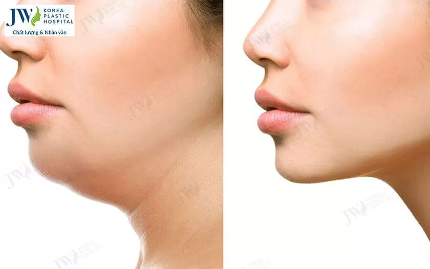 mỡ nọng cằm