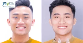 nieng rang smart jw