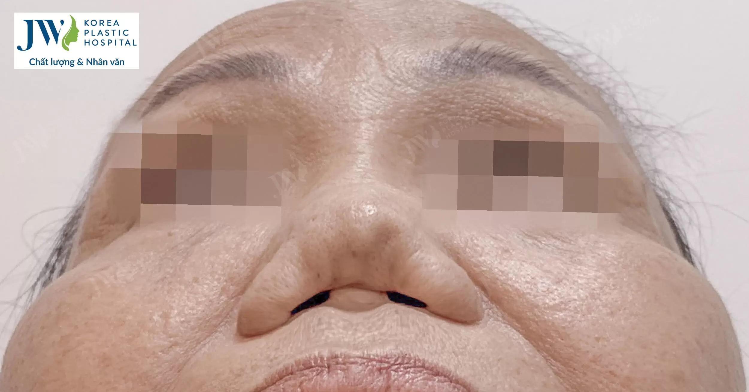 Bán cả gia tài, sửa mũi 7 lần khiến người phụ nữ Miền tây suýt tắt thở