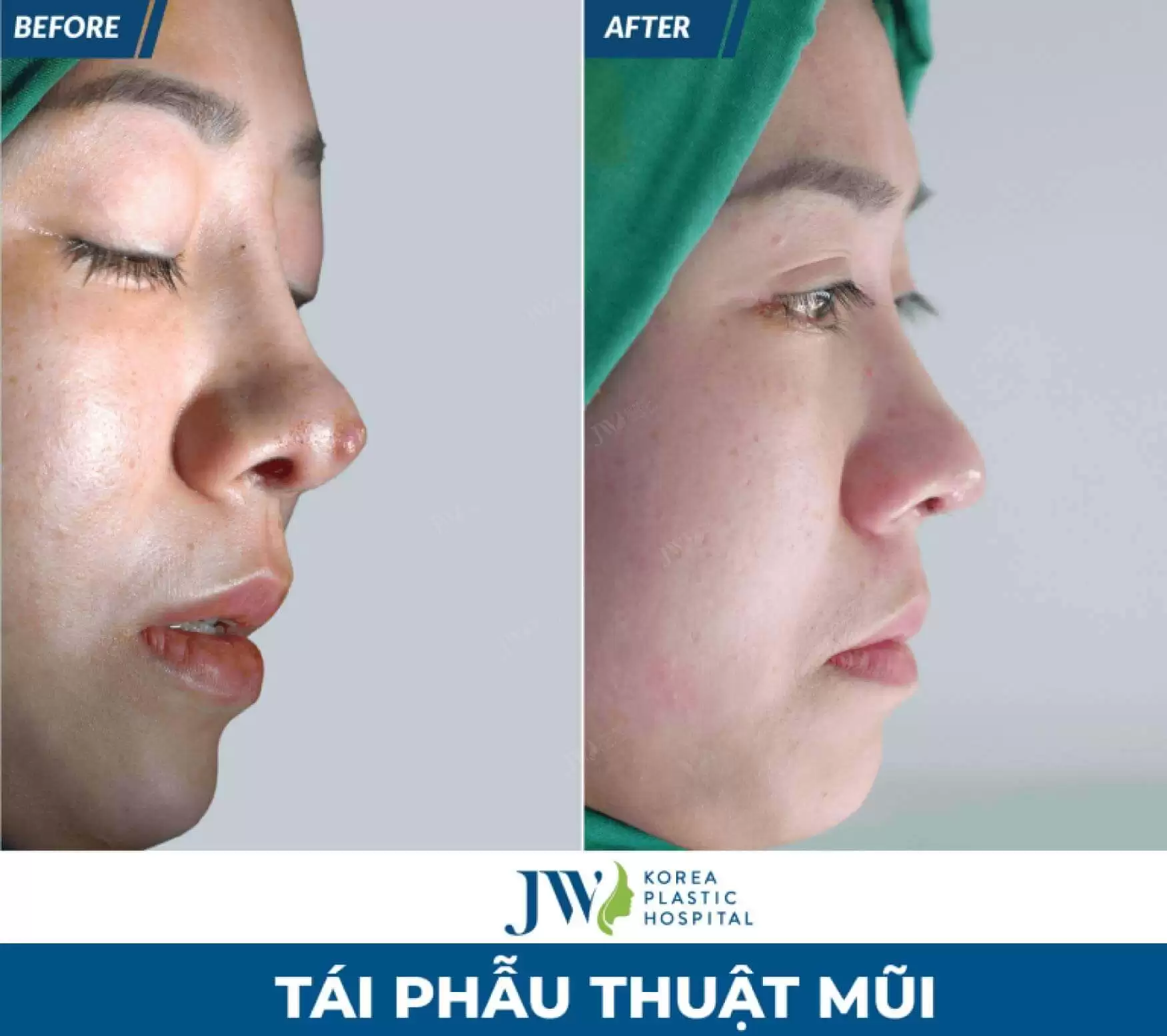 tai phau thuat mui 1 