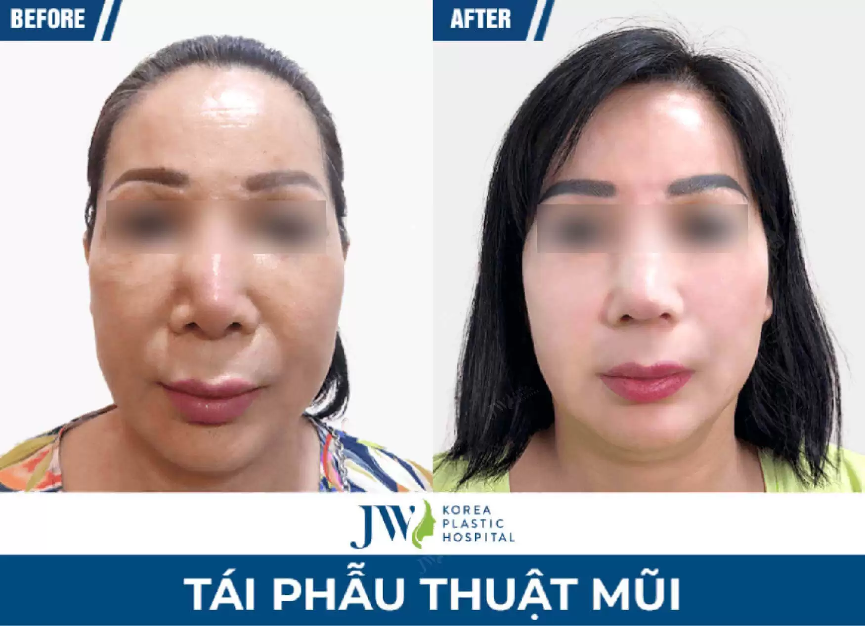 tai phau thuat mui jw