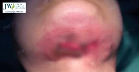 tiêm mỡ nọng cằm