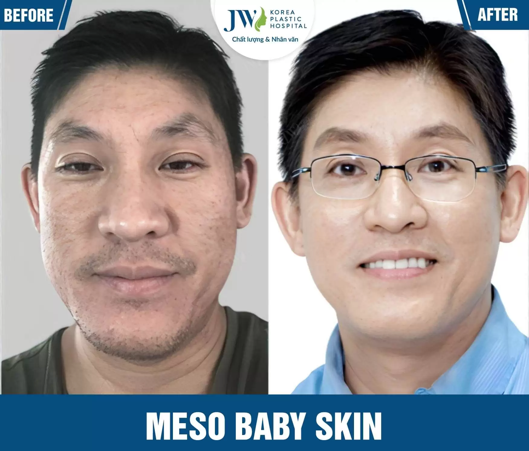 da mun tiem meso baby skin duoc khong