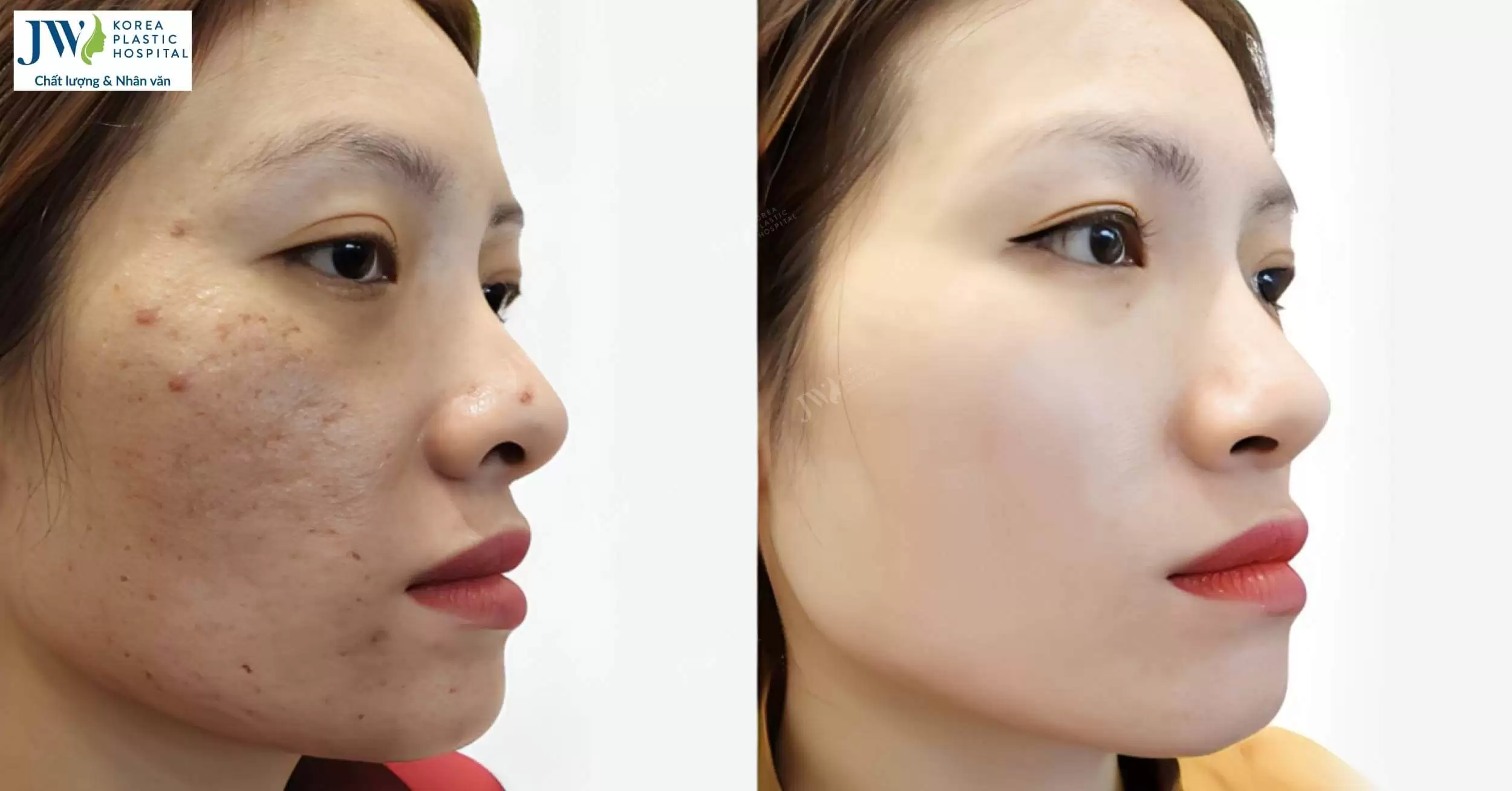 Mesotox giải pháp xóa nhăn giúp se khít lỗ chân lông