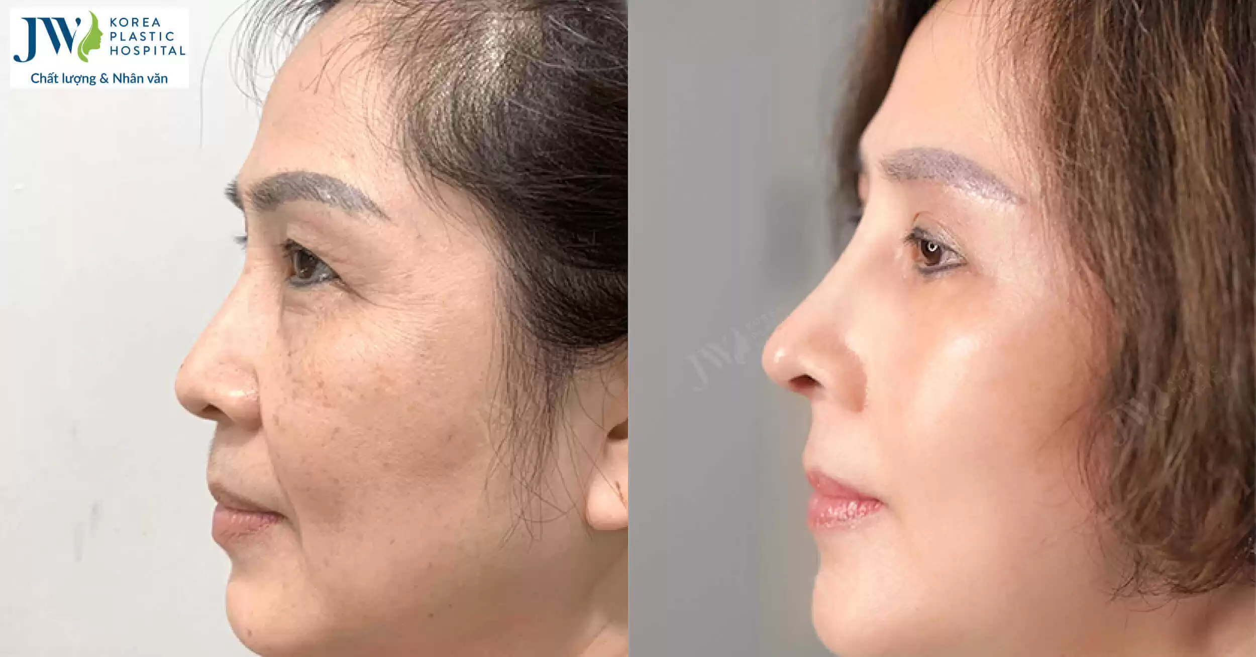 Nâng mũi khi về già: Những rủi ro nguy hiểm và cách phòng tránh