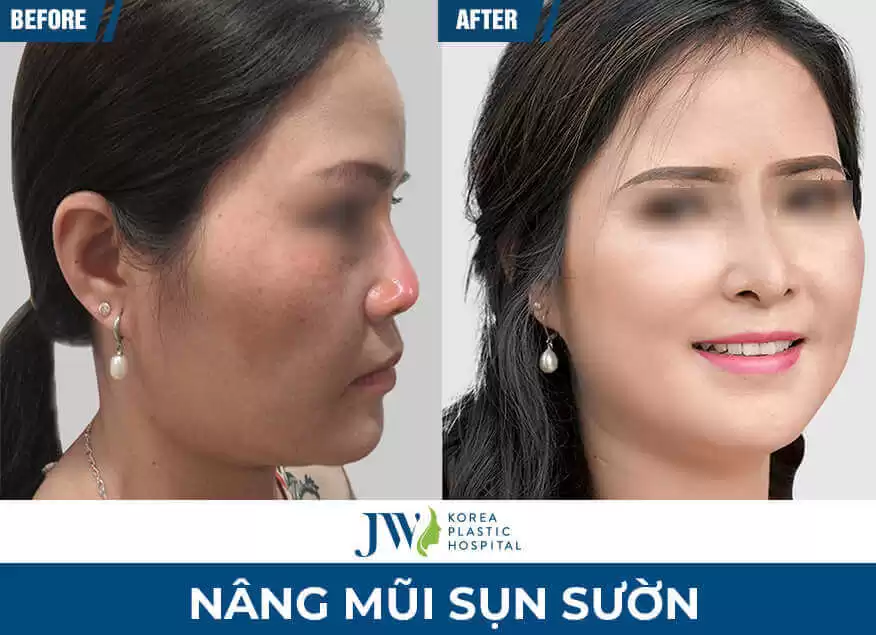 nang mui o dau