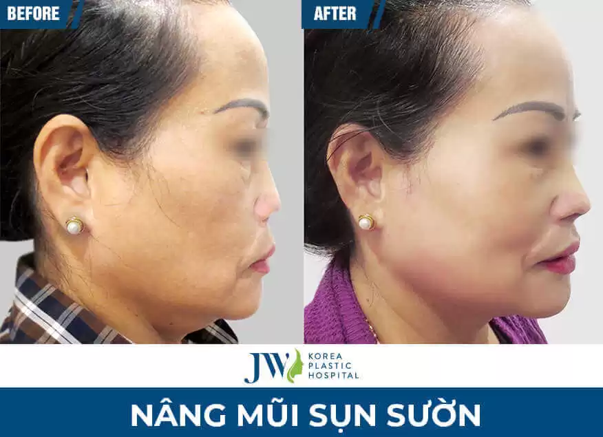 nang mui o dau uy tin