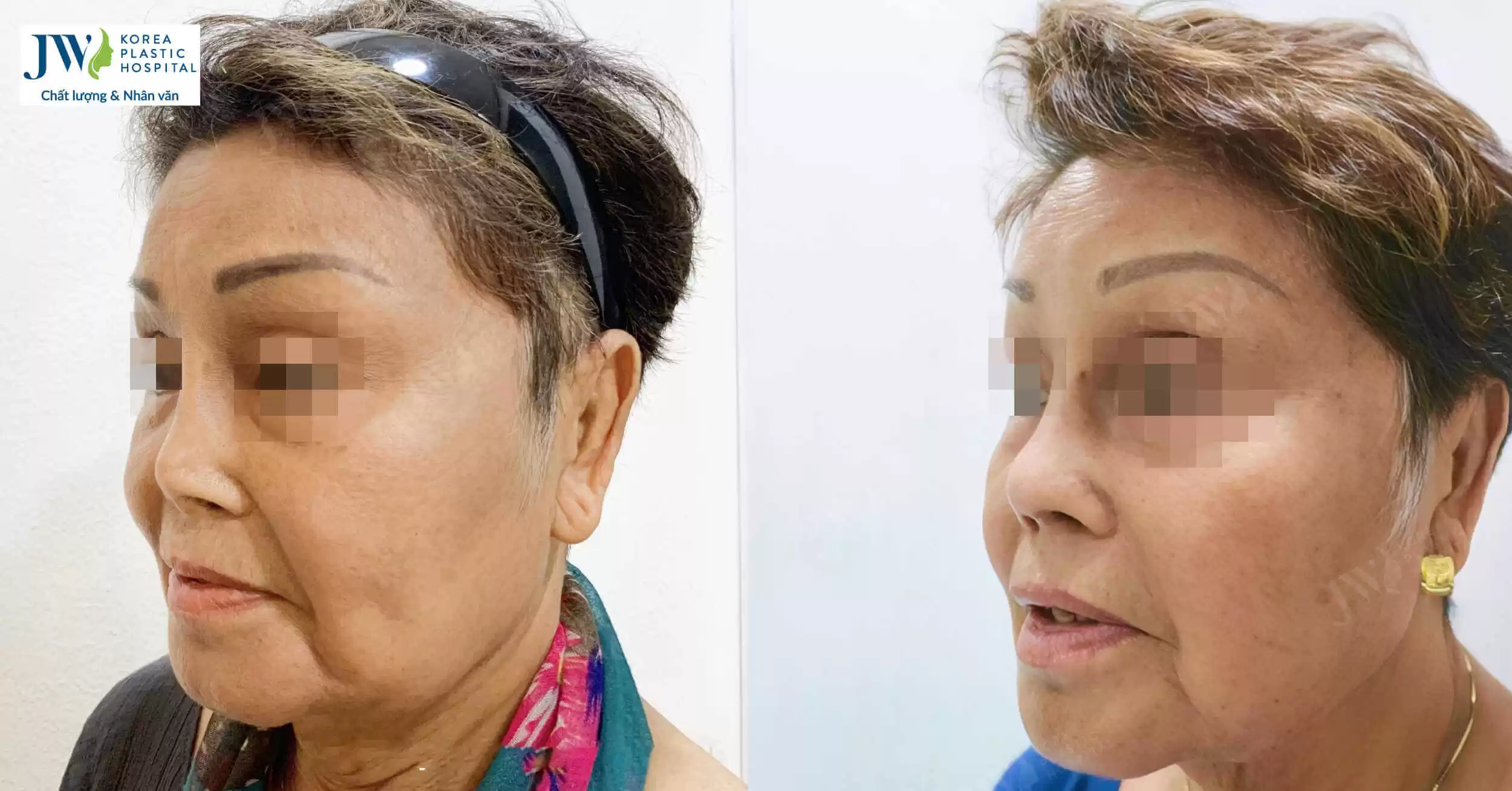 Nâng mũi sụn sườn: Cấp cứu mũi co rút cho Cụ bà người Mỹ U80 lớn tuổi nhất thế giới