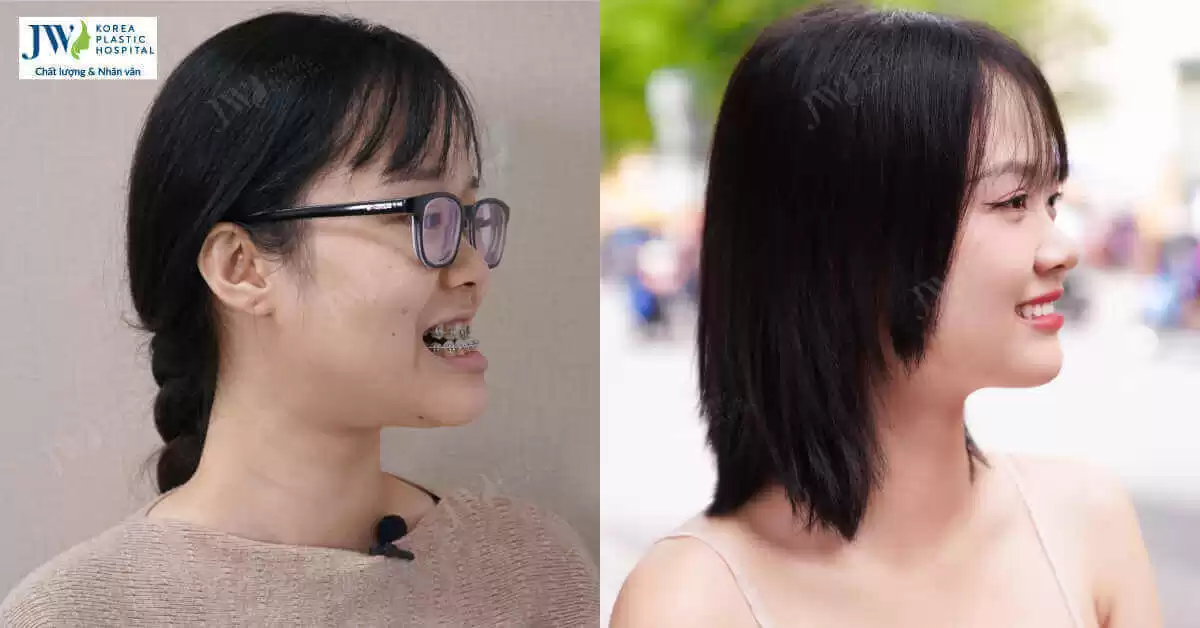 Từ “Cá Mặt Móm” đến Nàng Hậu Gen Z: Câu chuyện phẫu thuật hàm móm ngoạn mục