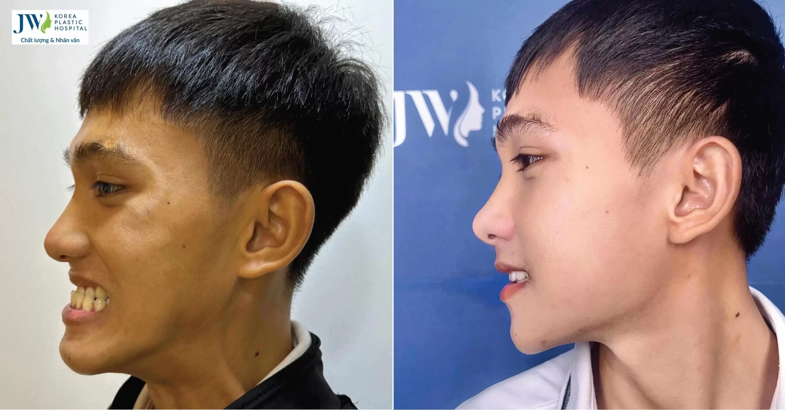 Phẫu thuật hàm móm giúp chàng trai GenZ trở thành Hot Boy vạn người mê