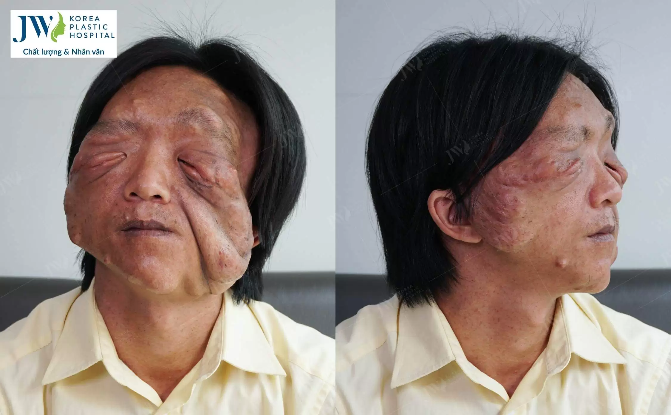 Pu phẫu thuật thẩm mỹ gây sốt với diện mạo mới