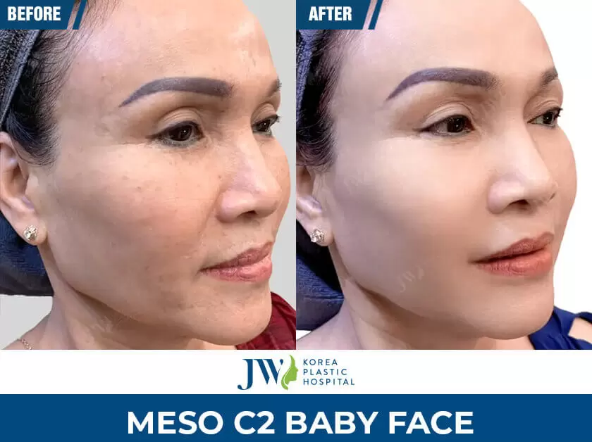 meso c2 baby face