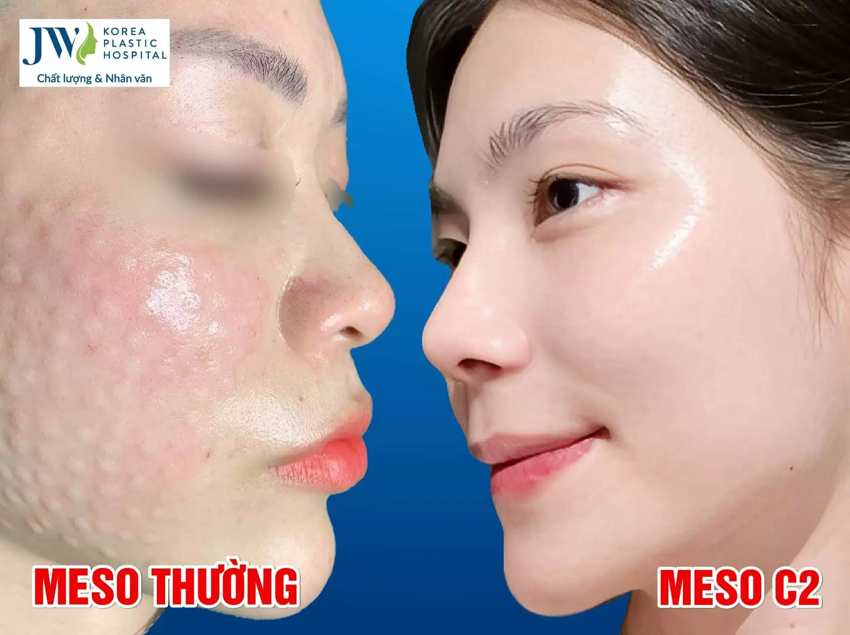 meos c2 khong phau thuat