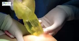 dấu hiệu nâng ngực