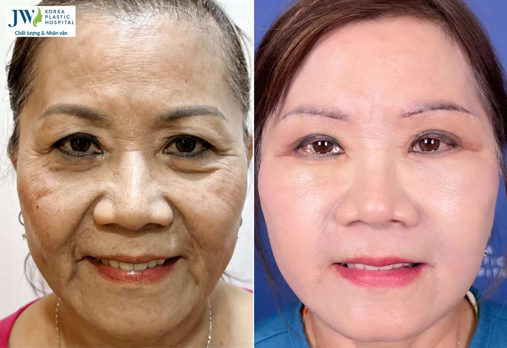 Việt kiều U70 thực hiện Cải lão gương mặt trẻ hóa toàn diện