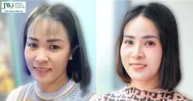 cắt mí mắt