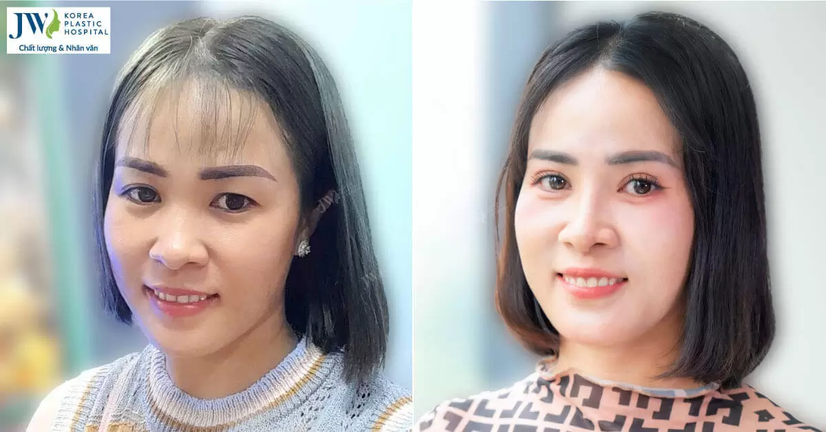Chị gái U40 cắt mí mắt tại Bệnh viện JW trẻ trung như gái 18 