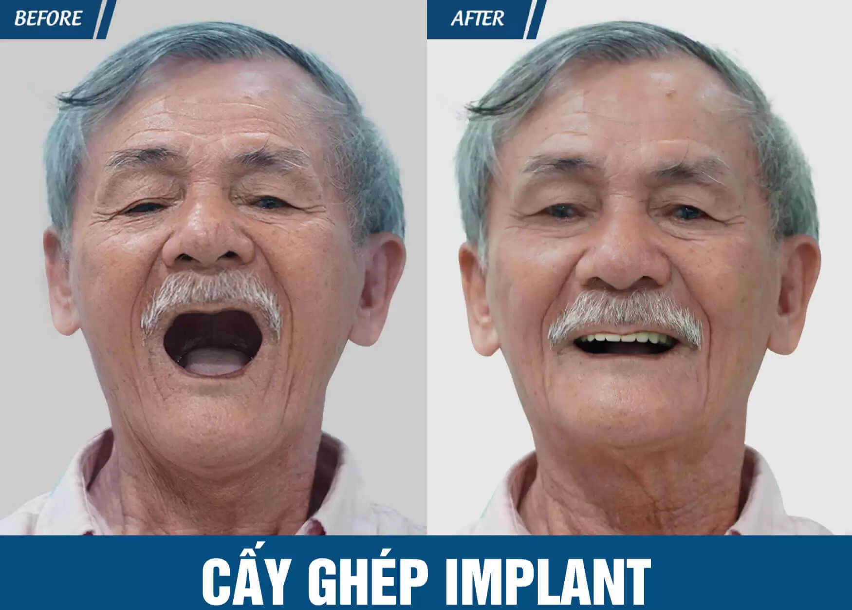 trong-rang-implant