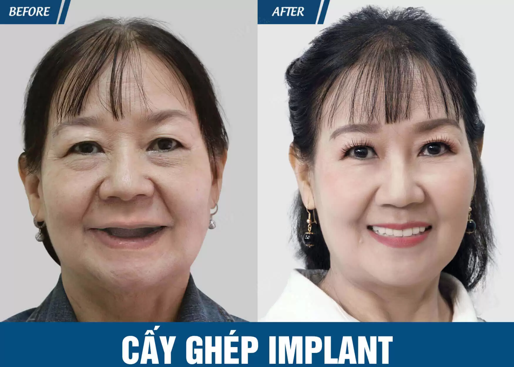 cay-ghep-implant