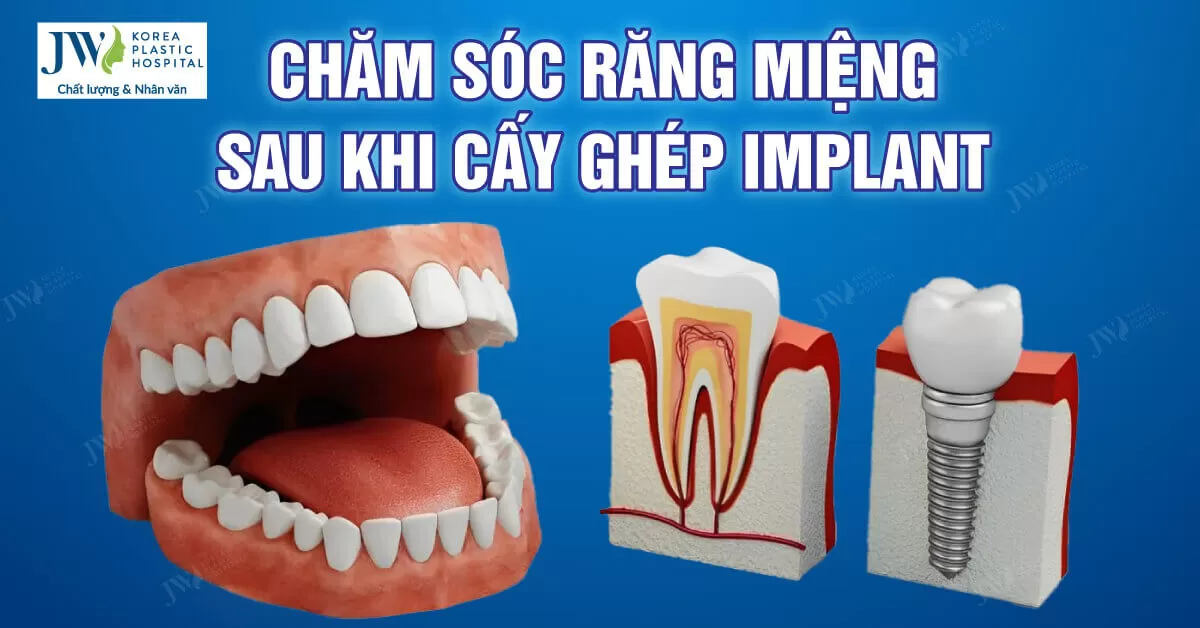Hướng dẫn chăm sóc răng miệng sau cấy ghép implant
