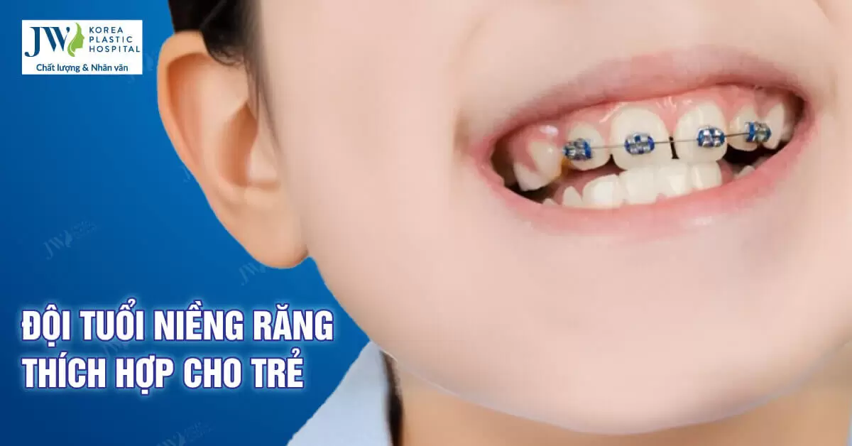 Độ tuổi niềng răng cho trẻ thế nào là phù hợp? 