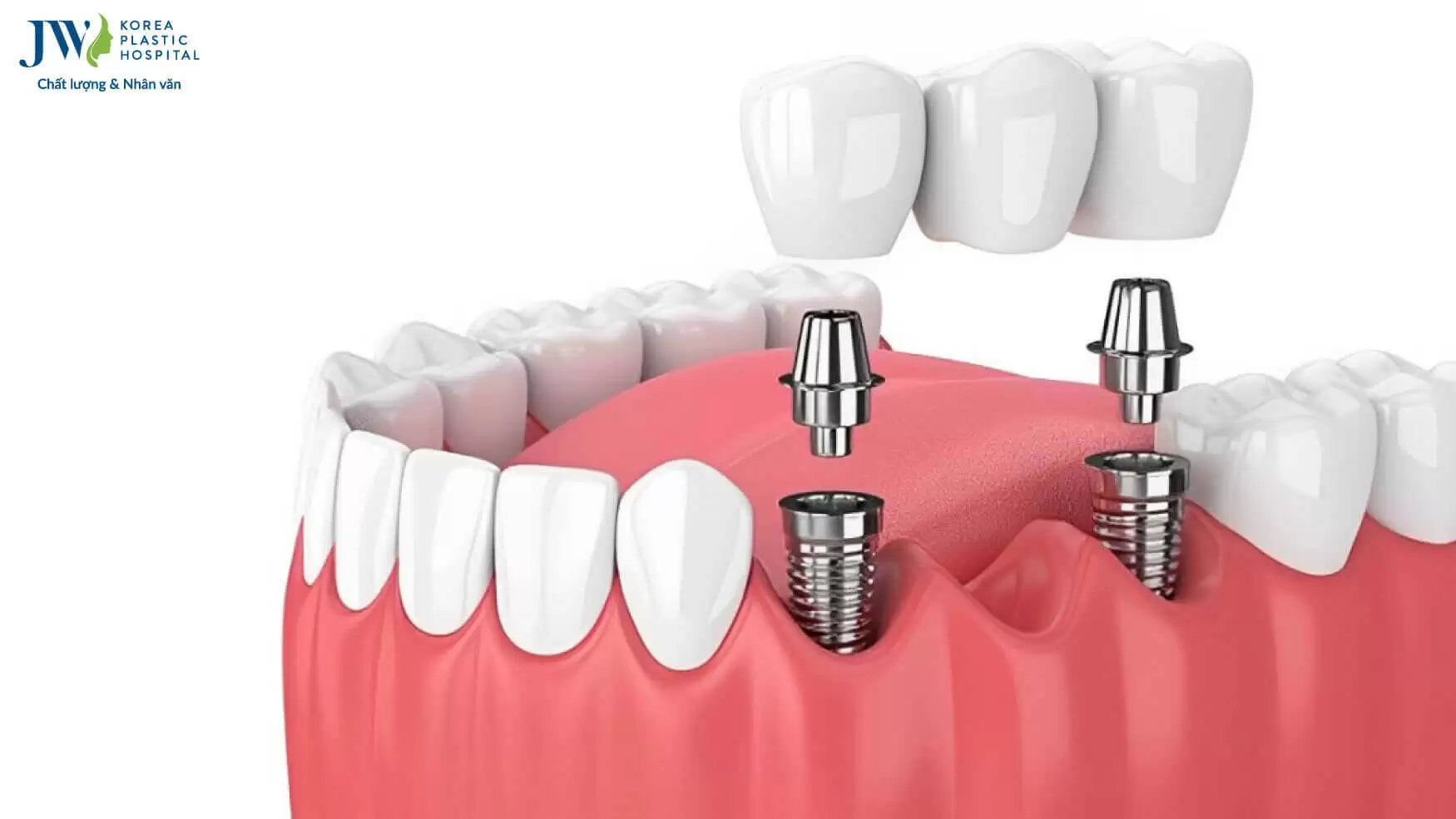 gan-rang-su-len-implant