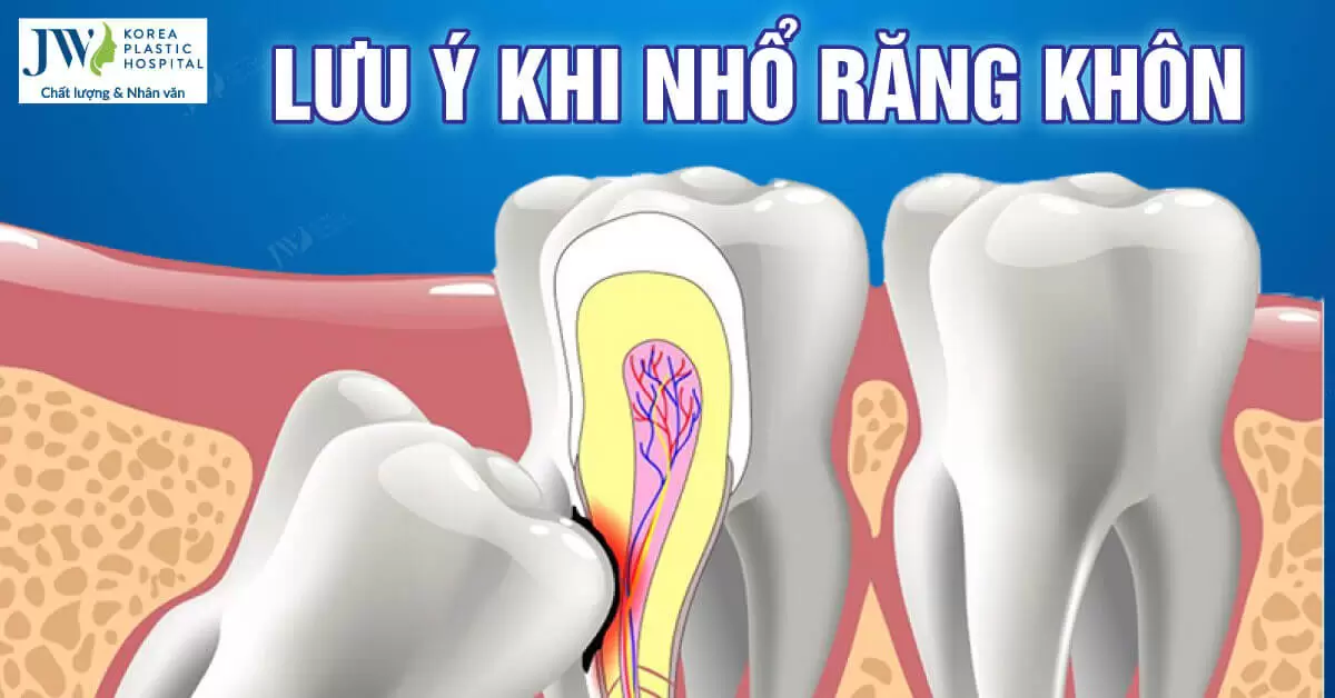 Nhổ răng khôn: Những lưu ý bạn không nên bỏ qua 