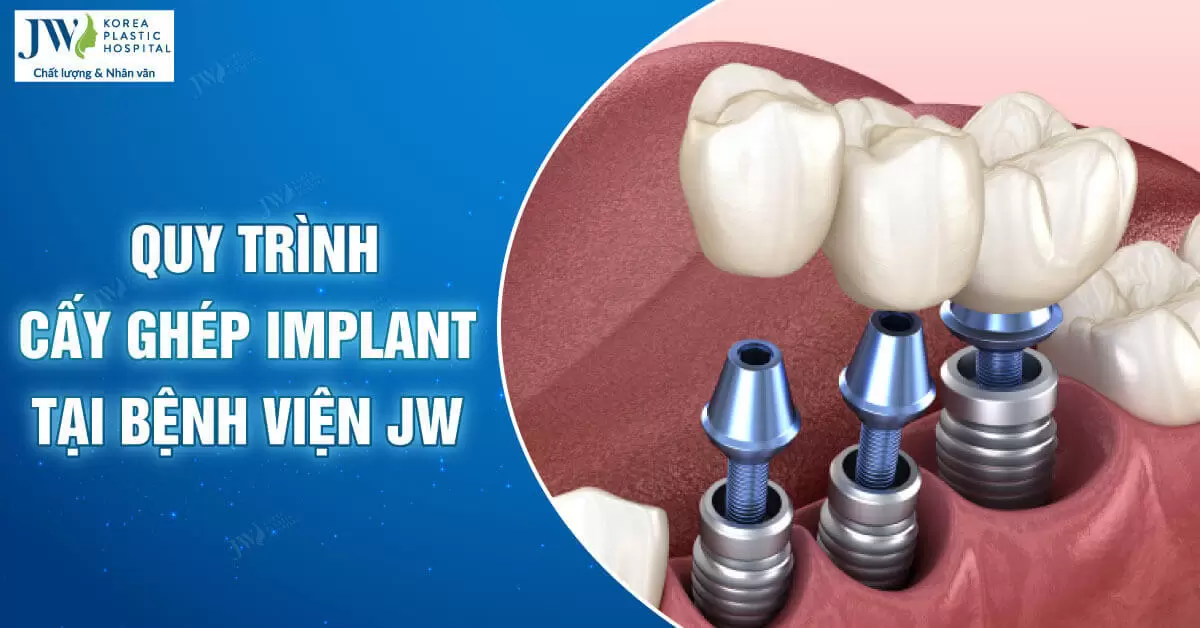 Quy trình cấy ghép Implant từ A-Z tại Bệnh viện JW