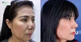 sửa mũi