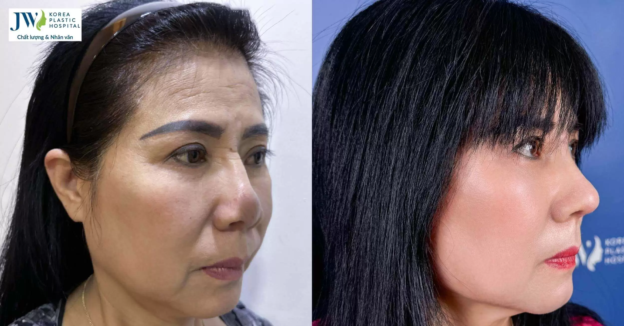 Bác sĩ Tú Dung sửa mũi hỏng canxi hóa 20 năm cho Việt kiều Úc 