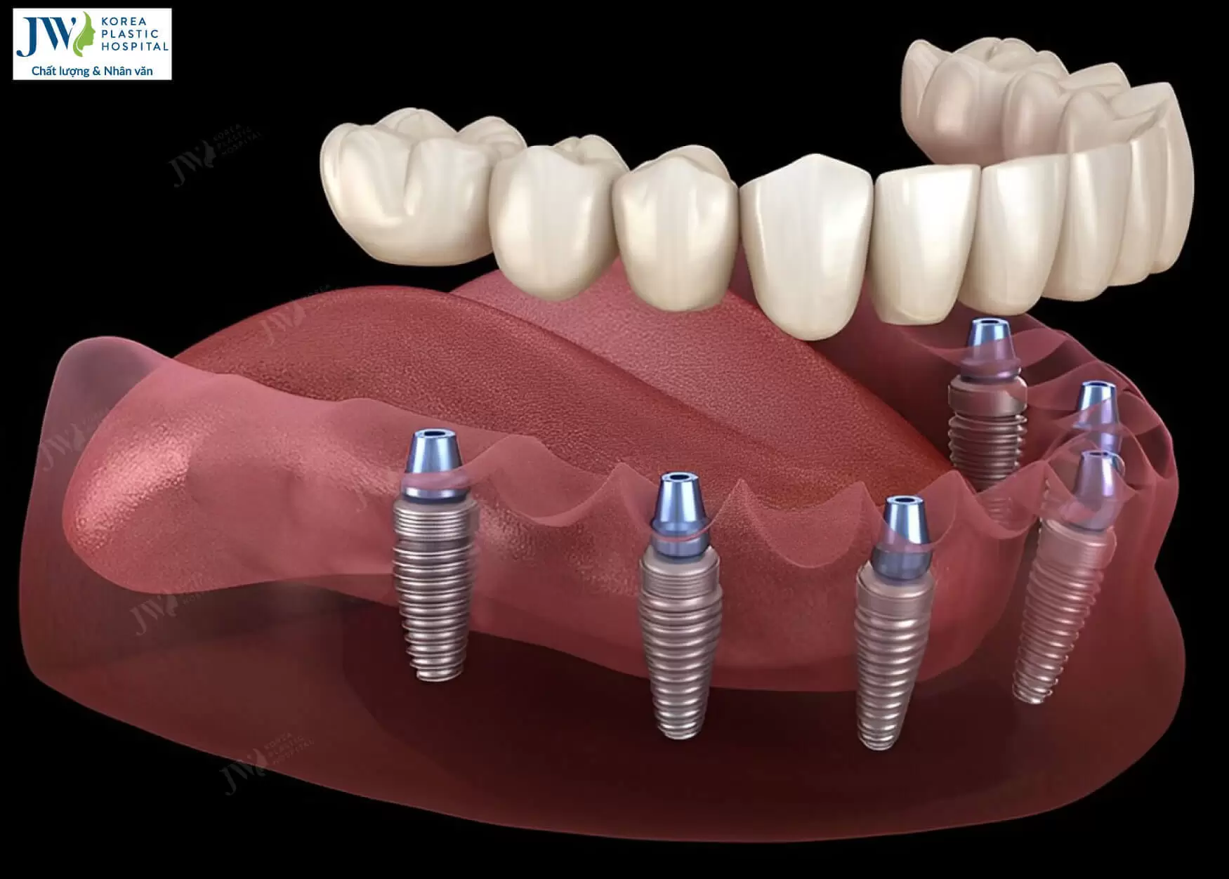 tien-hanh-cay-ghep-implant