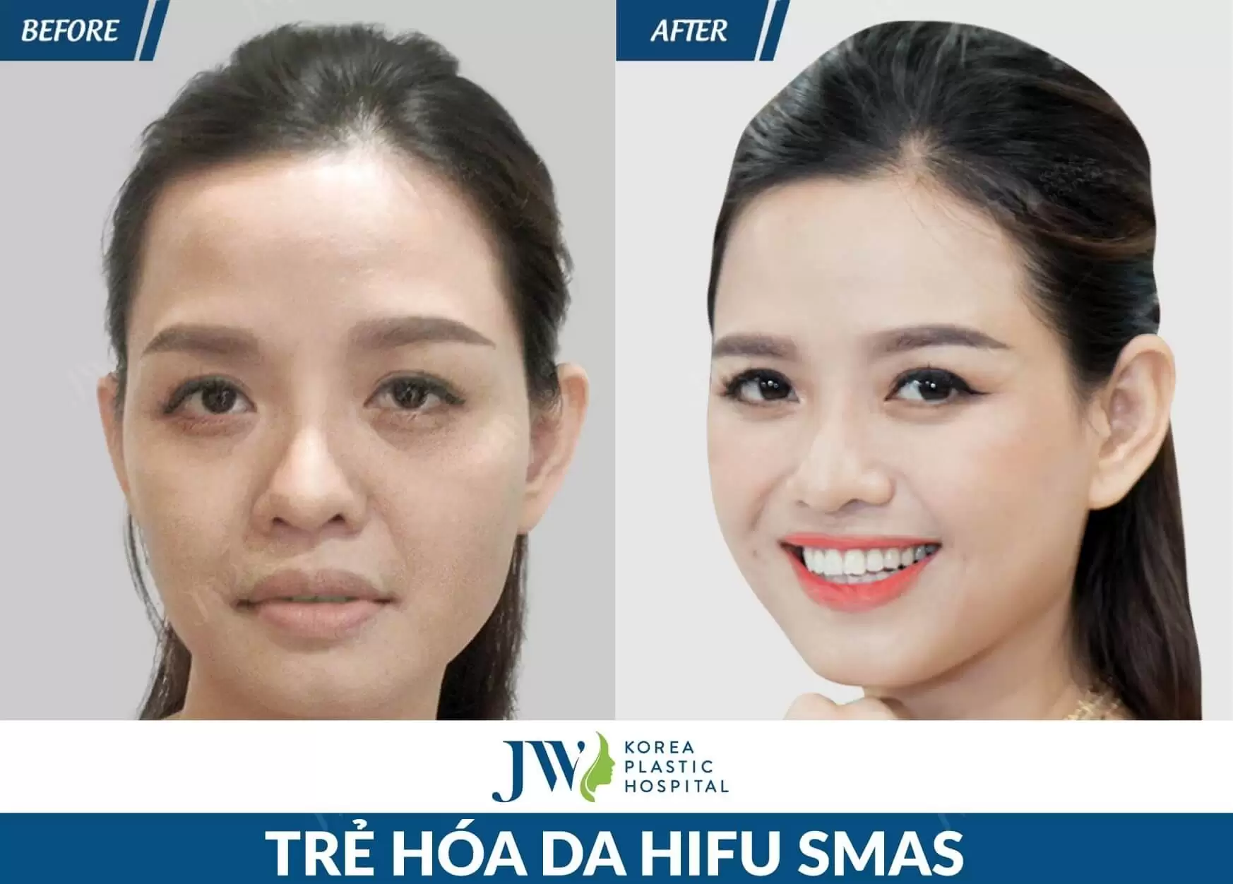 tre hoa da hifu smas
