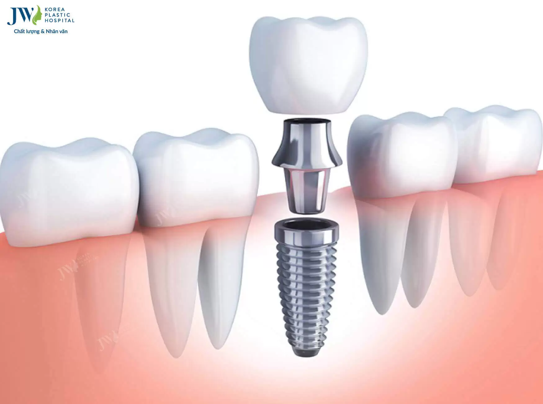 cay-ghep-implant-la-gi