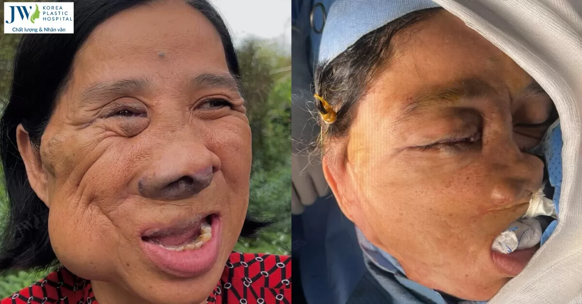 Cô Màng có mặt mới sau 4 giờ phẫu thuật cắt u sát sọ, chuyển vạt căng da mặt SMAS