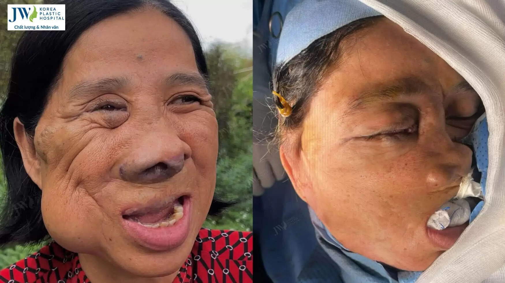co mang mien tay duoc bac si tu dung dieu tri thanh cong