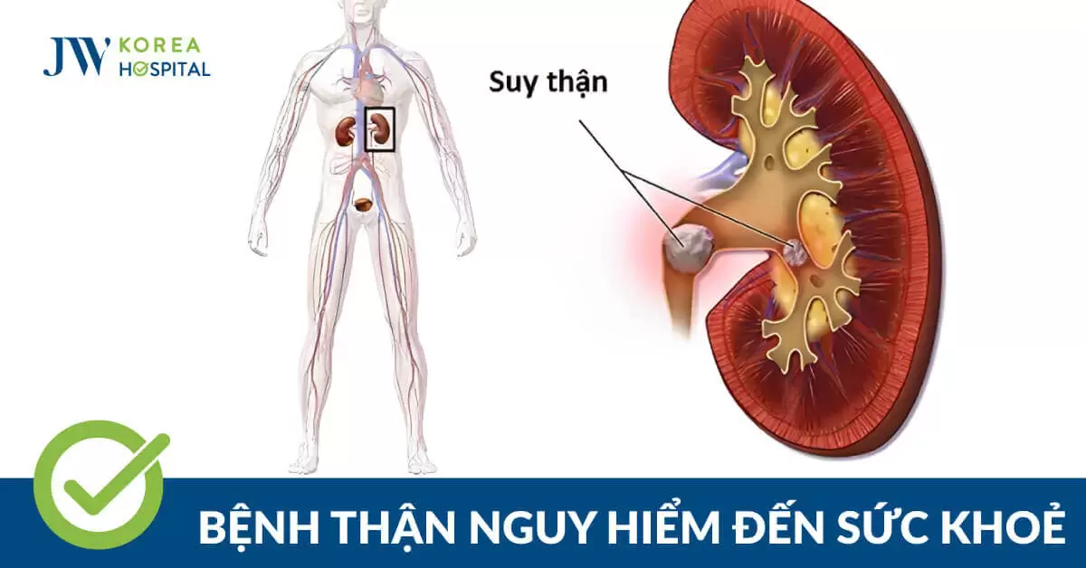 Bệnh thận ảnh hưởng nguy hiểm đến sức khoẻ như thế nào?