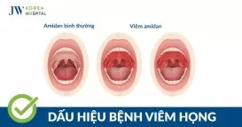 viêm họng