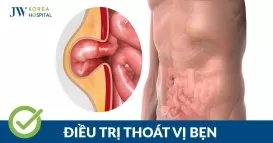 thoát vị bẹn