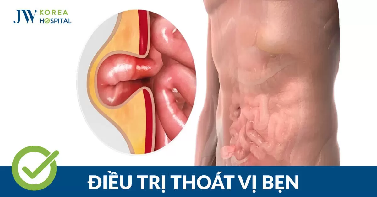 Thoát vị bẹn: Nguyên nhân, dấu hiệu, cách điều trị hiệu quả