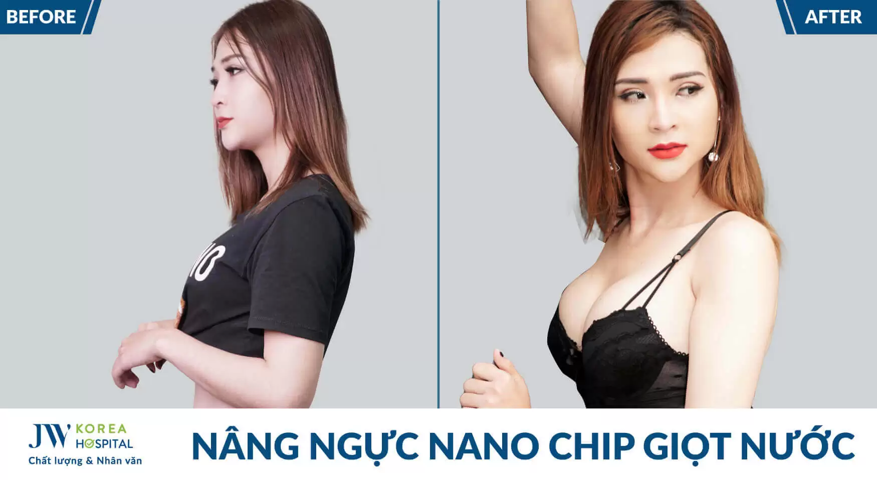 Nâng ngực Nano chip 3D – Tôn tạo vòng 1 đầy đặn như ý