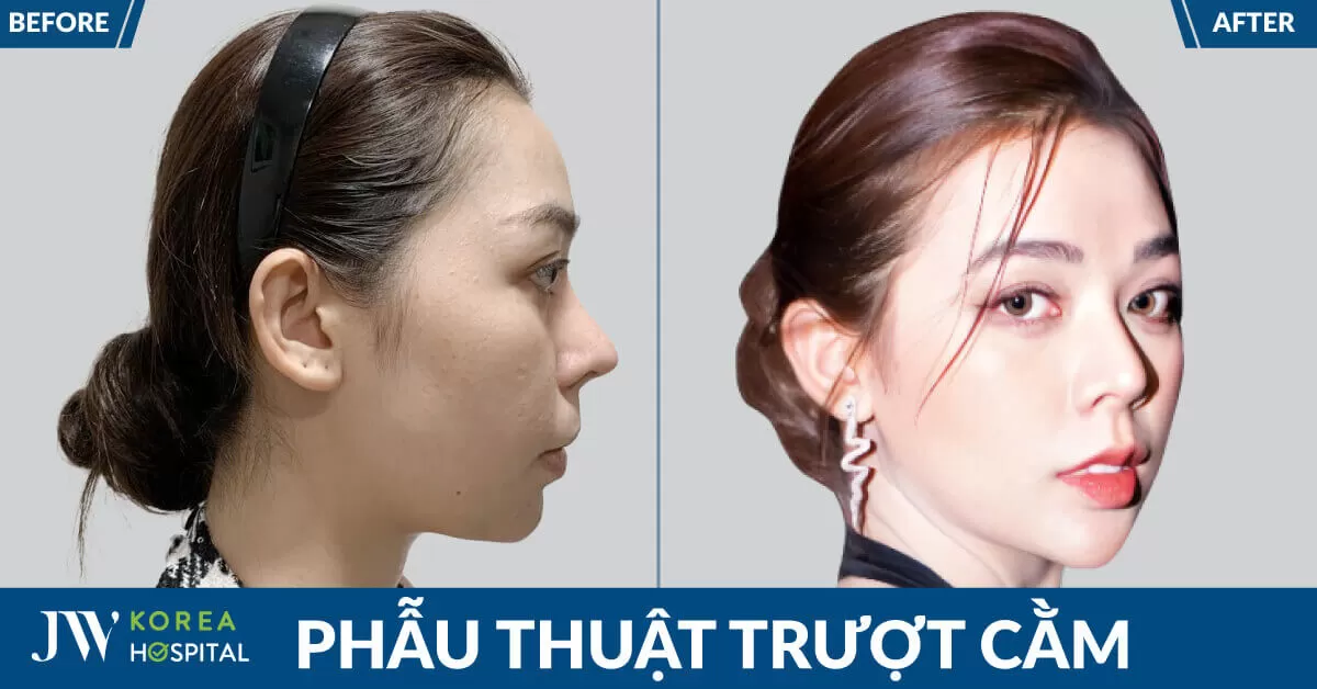 Hot Tiktoker Quỳnh Miêu Trượt Cằm Sở Hữu Gương Mặt V-Line Hoàn Hảo