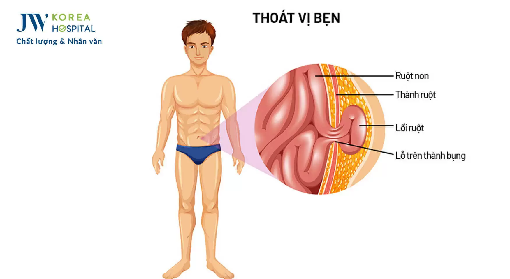 thoat-vi-ben