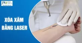 xóa xăm